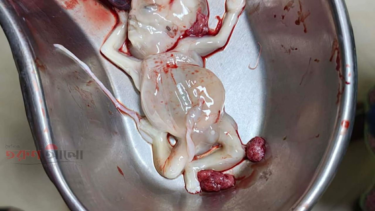 রূপগঞ্জে পেটে লাথি মেরে গর্ভের   সন্তান হত্যার অভিযোগ